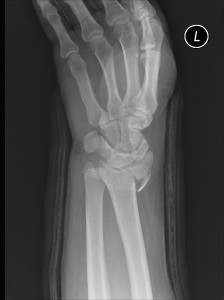 An X-Ray showing Jeff's Left Wrist fracture