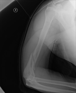 An X-Ray showing Jeff's right arm fracture